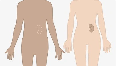 Transplantation