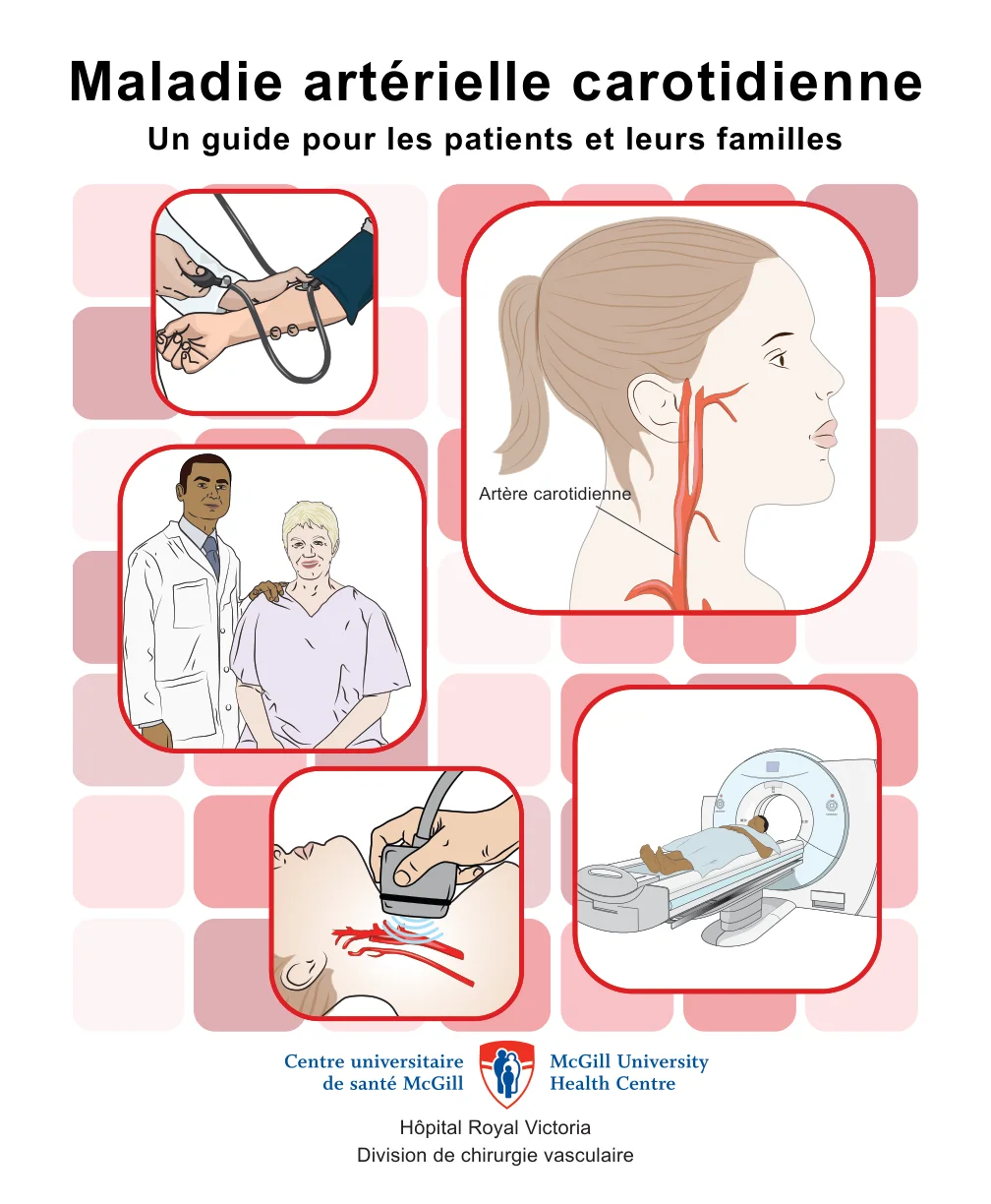 Maladie artérielle carotidienne