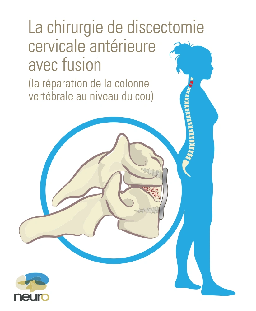 Anterior discectomy and fusion surgery
