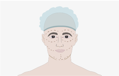 Chirurgie plastique